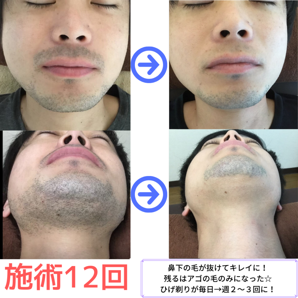 ひげ脱毛１２回
